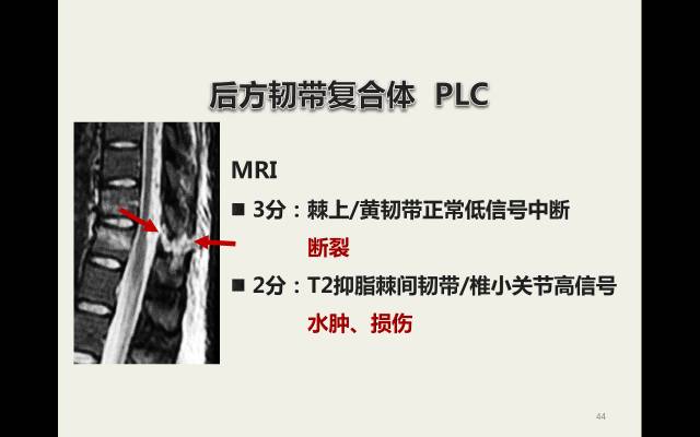 【病例】胸腰椎损伤分型及严重程度评分(TLICS)：影像与临床