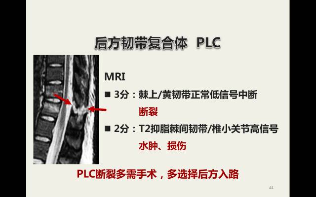 【病例】胸腰椎损伤分型及严重程度评分(TLICS)：影像与临床