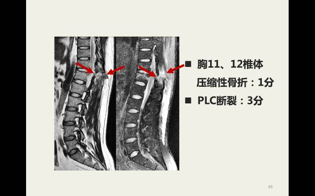 【病例】胸腰椎损伤分型及严重程度评分(TLICS)：影像与临床