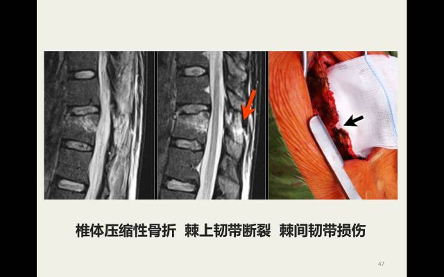 【病例】胸腰椎损伤分型及严重程度评分(TLICS)：影像与临床