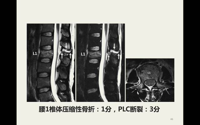 【病例】胸腰椎损伤分型及严重程度评分(TLICS)：影像与临床