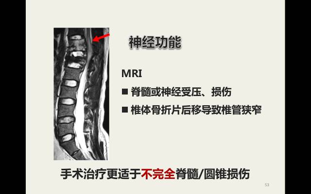 【病例】胸腰椎损伤分型及严重程度评分(TLICS)：影像与临床