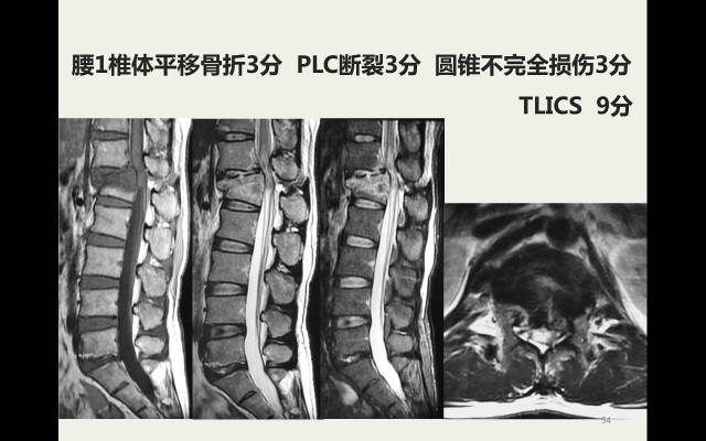 【病例】胸腰椎损伤分型及严重程度评分(TLICS)：影像与临床