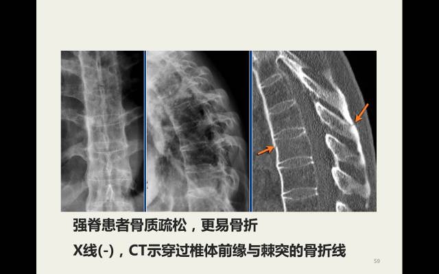 【病例】胸腰椎损伤分型及严重程度评分(TLICS)：影像与临床