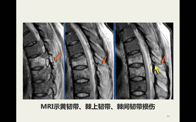 【病例】胸腰椎损伤分型及严重程度评分(TLICS)：影像与临床