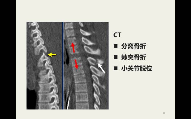 【病例】胸腰椎损伤分型及严重程度评分(TLICS)：影像与临床