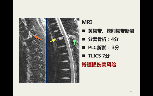 【病例】胸腰椎损伤分型及严重程度评分(TLICS)：影像与临床