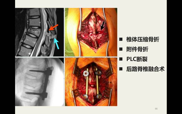 【病例】胸腰椎损伤分型及严重程度评分(TLICS)：影像与临床