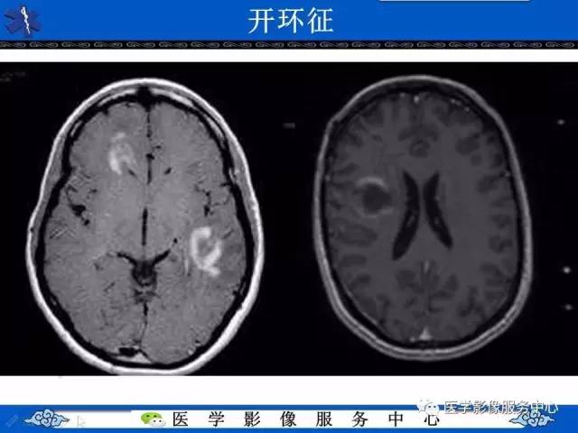 【影像征象】开环征——脱髓鞘假瘤