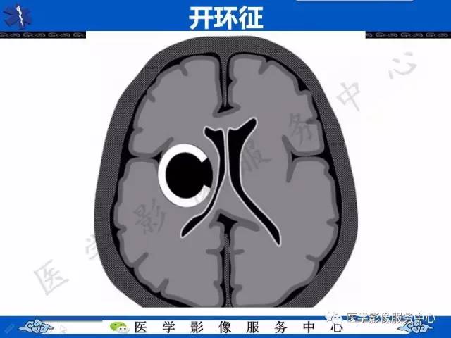 【影像征象】开环征——脱髓鞘假瘤