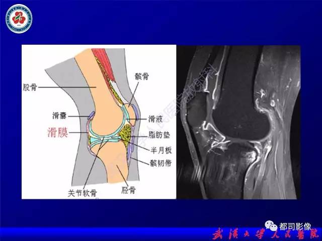 【PPT】膝关节常见囊性病变MRI诊断