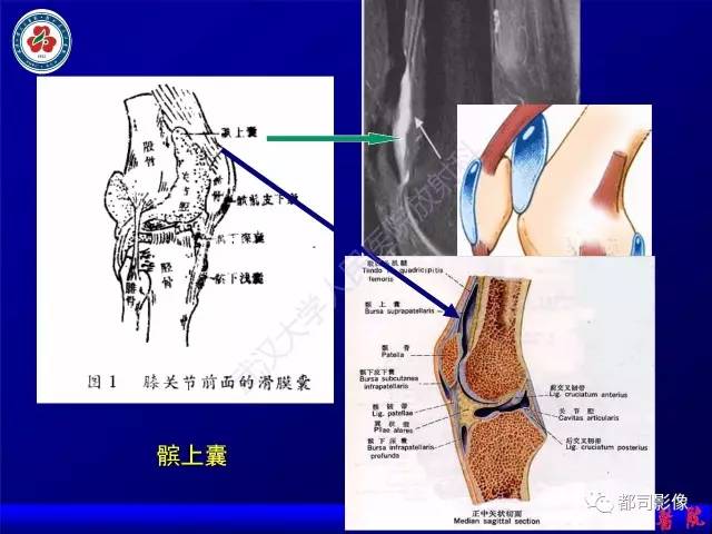 【PPT】膝关节常见囊性病变MRI诊断