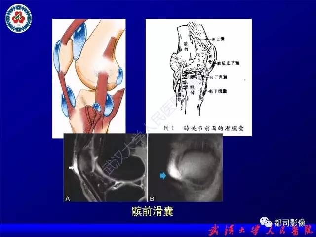 【PPT】膝关节常见囊性病变MRI诊断