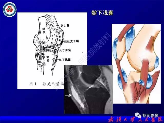 【PPT】膝关节常见囊性病变MRI诊断
