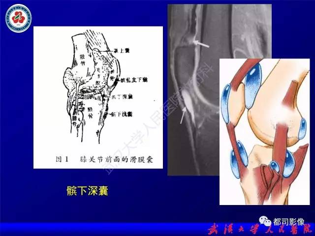 【PPT】膝关节常见囊性病变MRI诊断