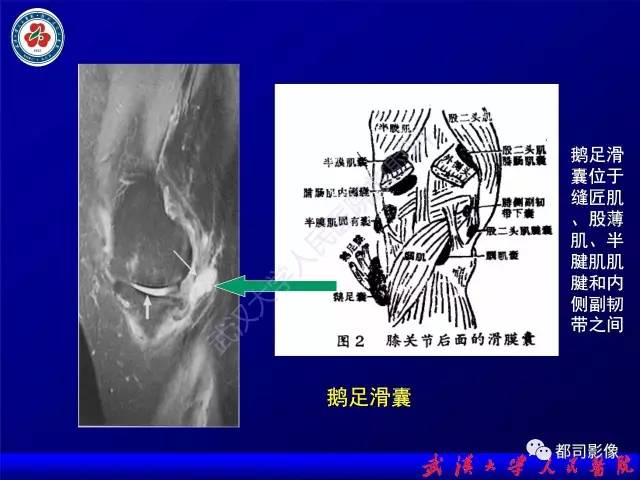 【PPT】膝关节常见囊性病变MRI诊断