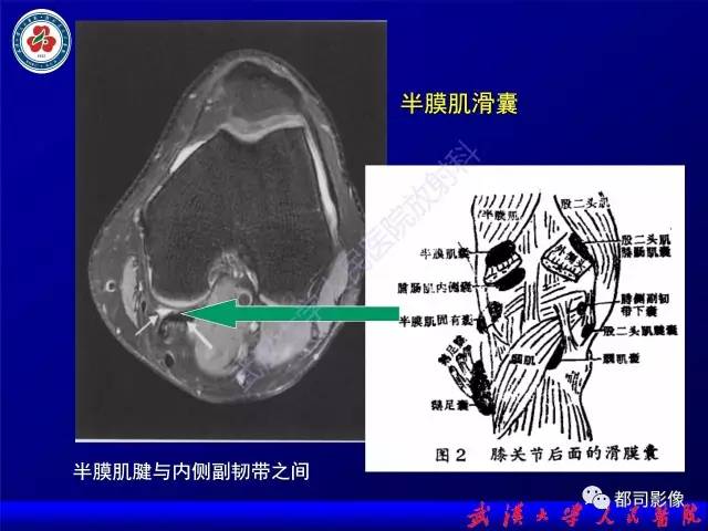【PPT】膝关节常见囊性病变MRI诊断
