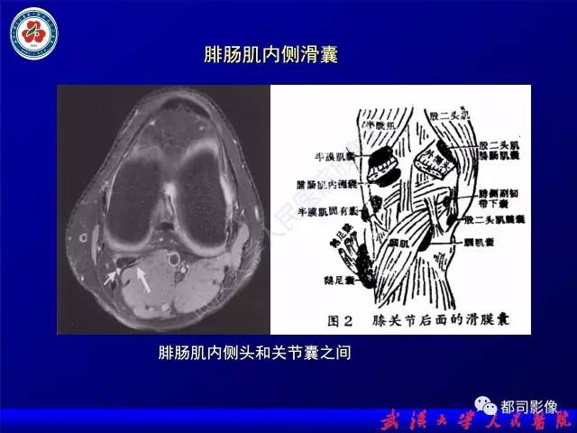 【PPT】膝关节常见囊性病变MRI诊断