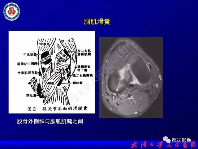 【PPT】膝关节常见囊性病变MRI诊断