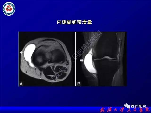 【PPT】膝关节常见囊性病变MRI诊断