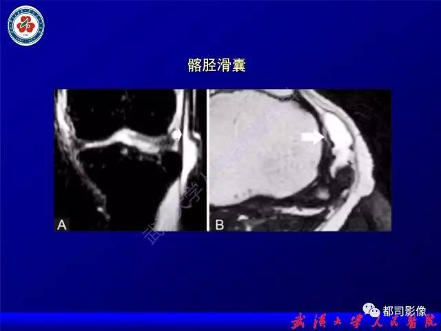 【PPT】膝关节常见囊性病变MRI诊断