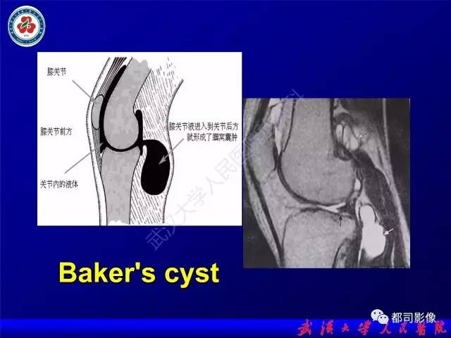 【PPT】膝关节常见囊性病变MRI诊断