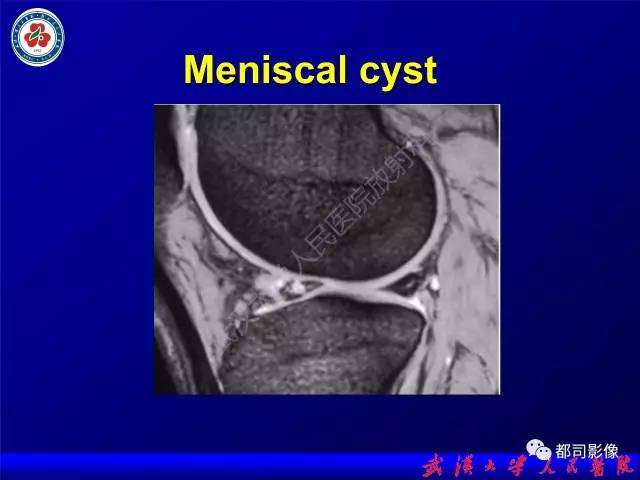 【PPT】膝关节常见囊性病变MRI诊断
