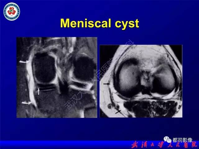 【PPT】膝关节常见囊性病变MRI诊断