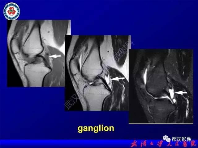 【PPT】膝关节常见囊性病变MRI诊断