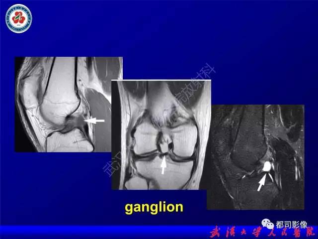 【PPT】膝关节常见囊性病变MRI诊断