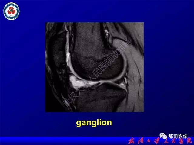 【PPT】膝关节常见囊性病变MRI诊断