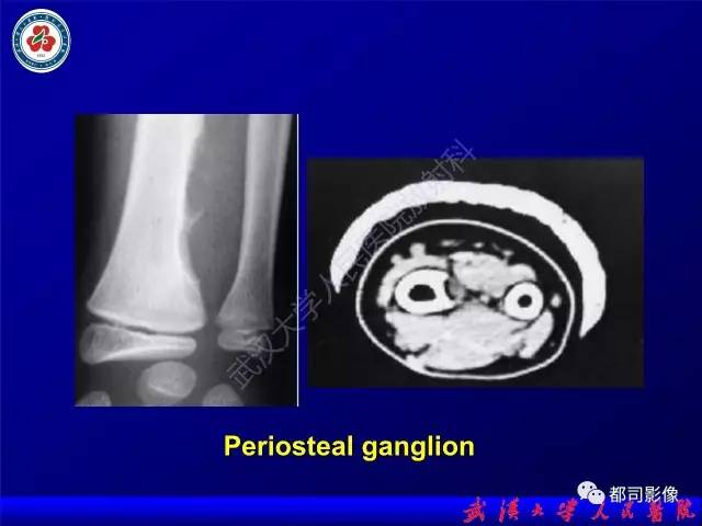 【PPT】膝关节常见囊性病变MRI诊断