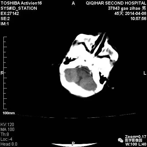【病例】先天性巨细胞病毒感染性脑病1例CT影像表现 【病例】先天性巨细胞病毒感染性脑病1例CT影像表现