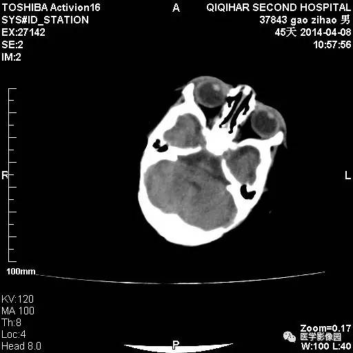 【病例】先天性巨细胞病毒感染性脑病1例CT影像表现 【病例】先天性巨细胞病毒感染性脑病1例CT影像表现