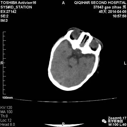 【病例】先天性巨细胞病毒感染性脑病1例CT影像表现 【病例】先天性巨细胞病毒感染性脑病1例CT影像表现
