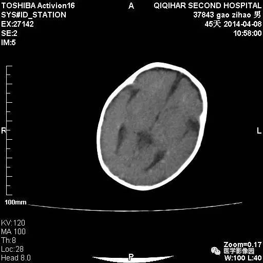 【病例】先天性巨细胞病毒感染性脑病1例CT影像表现 【病例】先天性巨细胞病毒感染性脑病1例CT影像表现