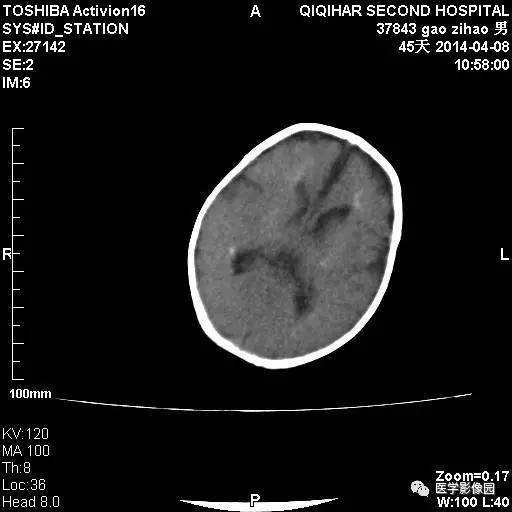 【病例】先天性巨细胞病毒感染性脑病1例CT影像表现 【病例】先天性巨细胞病毒感染性脑病1例CT影像表现