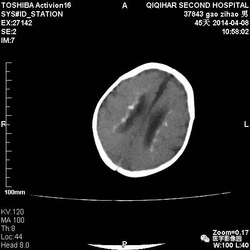 【病例】先天性巨细胞病毒感染性脑病1例CT影像表现