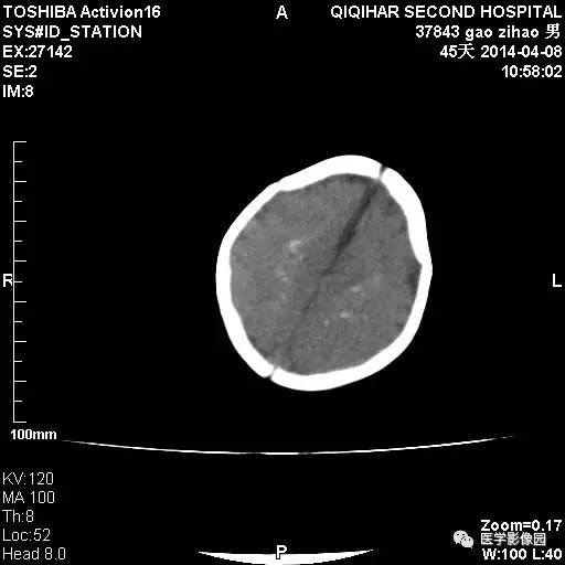 【病例】先天性巨细胞病毒感染性脑病1例CT影像表现 【病例】先天性巨细胞病毒感染性脑病1例CT影像表现
