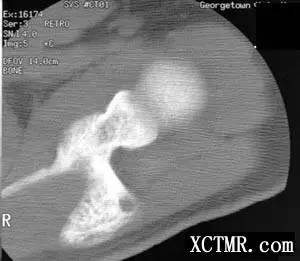 【病例】左肩锁关节上皮样血管瘤1例X线CT及MR 【病例】左肩锁关节上皮样血管瘤1例X线CT及MR