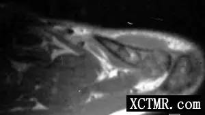 【病例】左肩锁关节上皮样血管瘤1例X线CT及MR 【病例】左肩锁关节上皮样血管瘤1例X线CT及MR