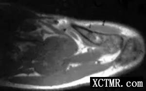 【病例】左肩锁关节上皮样血管瘤1例X线CT及MR 【病例】左肩锁关节上皮样血管瘤1例X线CT及MR