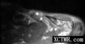 【病例】左肩锁关节上皮样血管瘤1例X线CT及MR 【病例】左肩锁关节上皮样血管瘤1例X线CT及MR