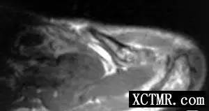 【病例】左肩锁关节上皮样血管瘤1例X线CT及MR 【病例】左肩锁关节上皮样血管瘤1例X线CT及MR