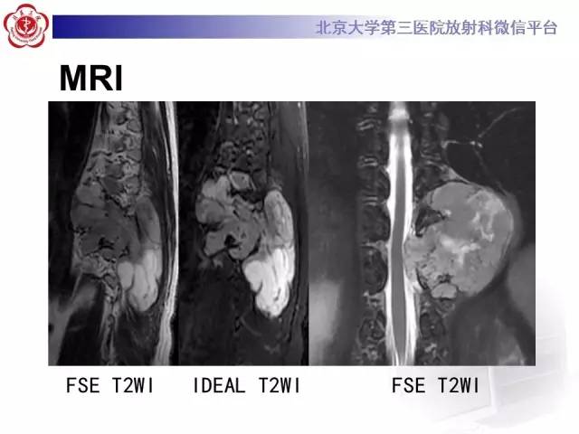 【病例】脊柱孤立性纤维瘤1例MR
