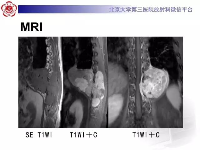 【病例】脊柱孤立性纤维瘤1例MR