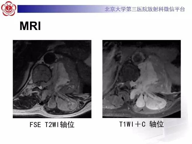 【病例】脊柱孤立性纤维瘤1例MR