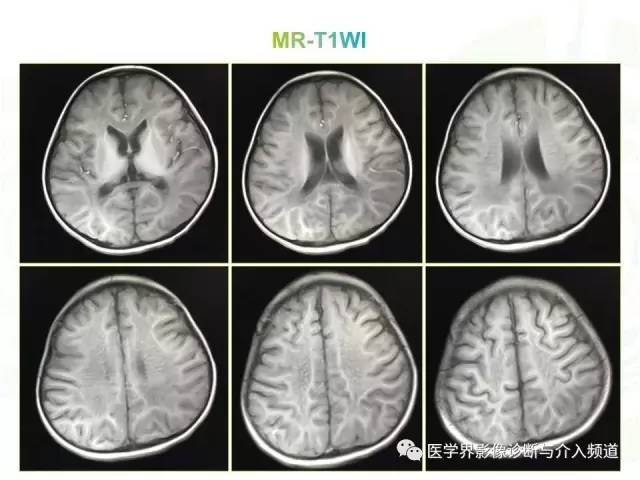 【病例】异染性脑白质营养不良1例MR影像诊断