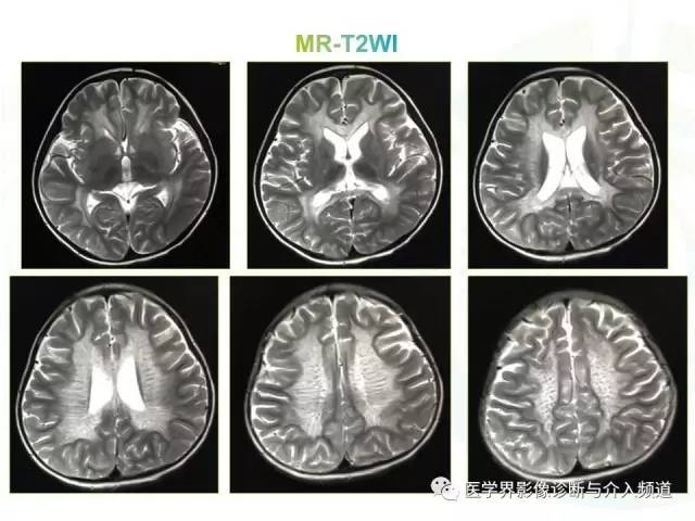 【病例】异染性脑白质营养不良1例MR影像诊断