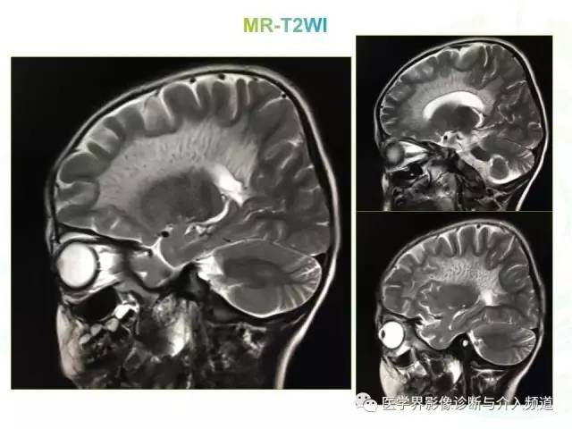 【病例】异染性脑白质营养不良1例MR影像诊断
